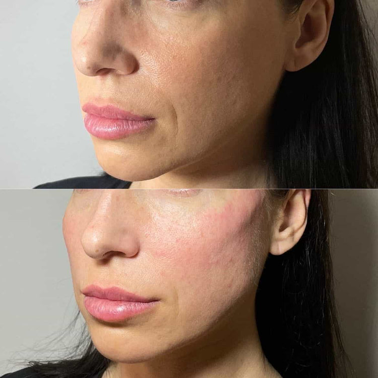 How to Choose the Right Cheek Treatment for Gaunt Faces in the UK