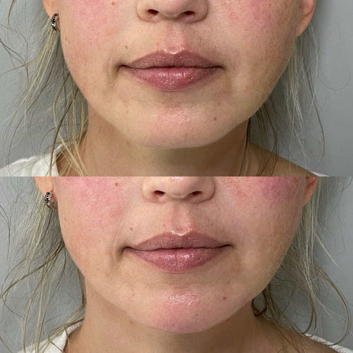 Where is the most painful place to get Botox?