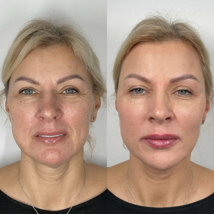 Botox Bunny Lines in Knightsbridge, London