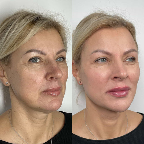 How Long Do Temple Fillers Last?
