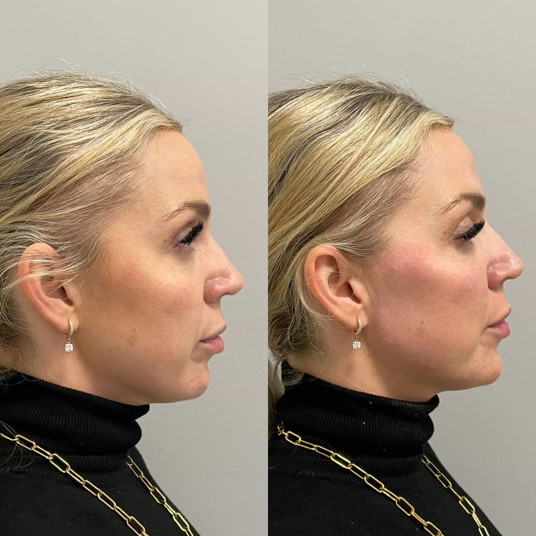 Botox Bunny Lines in Knightsbridge, London