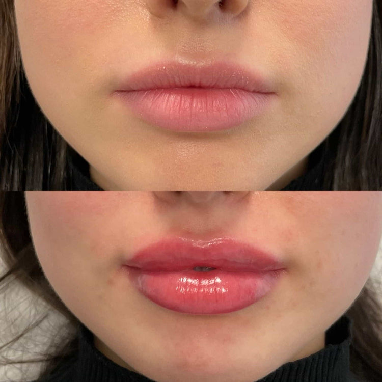 Tips for Reducing Bruising After Lip Injections