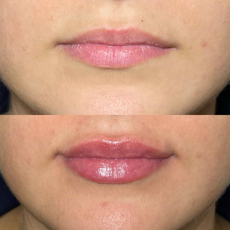 Tips for Reducing Bruising After Lip Injections