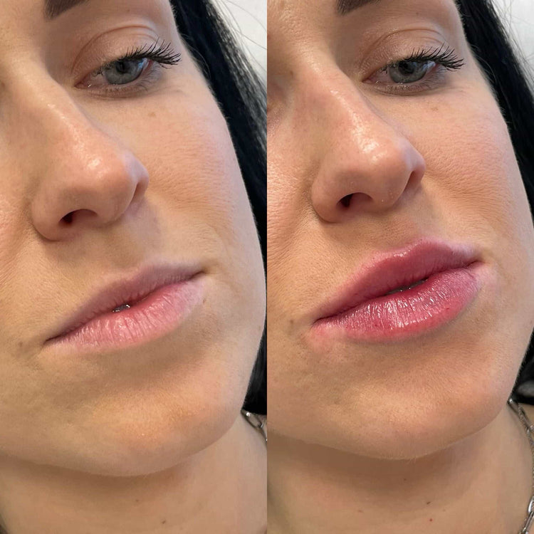 How does Pain Free Lip Filler work to create fuller lips in the UK