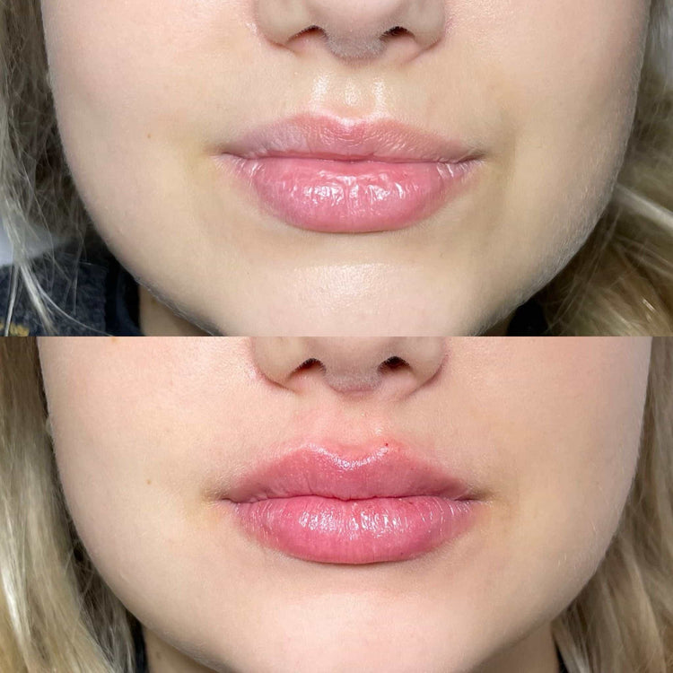 Are Lip Fillers Safe? Common Concerns and Risks Explained
