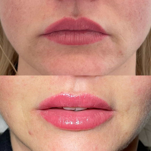 How Much To Get Lip Filler Dissolved