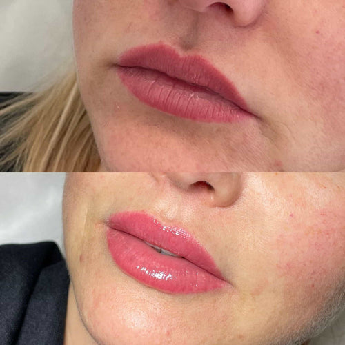 Does drinking water help tear trough filler?