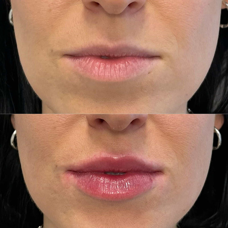 Are Lip Fillers Safe? Common Concerns and Risks Explained