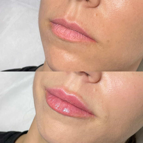 Does Filler In Cheeks Lift Jowls?