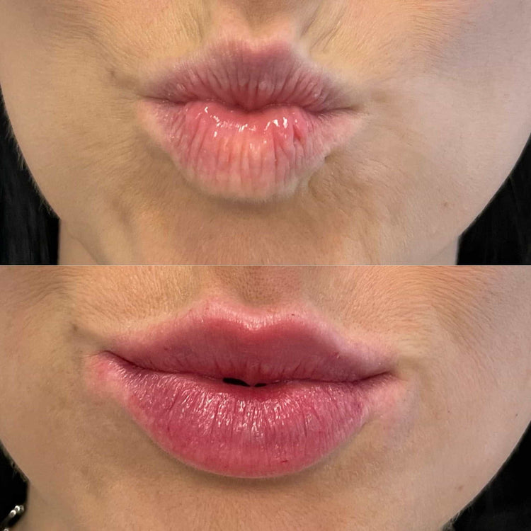 Are Lip Fillers Safe? Common Concerns and Risks Explained