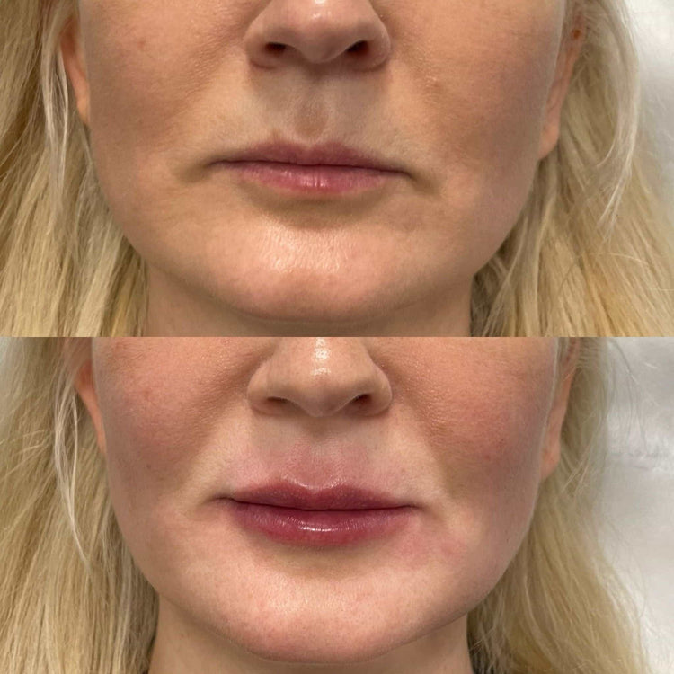 How Long Does Marionette Lines Filler Last in Kingston Upon Thames