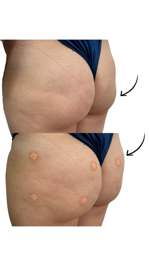 Non Surgical Butt Lift in Salfords Surrey