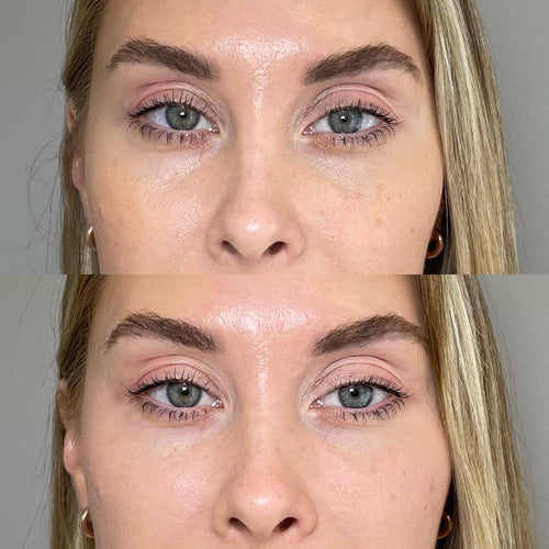 How Long Will Lips Be Sore After Fillers?