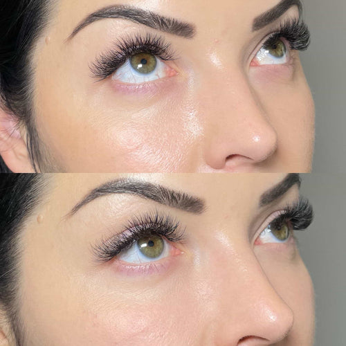 How To Sleep After Tear Trough Filler