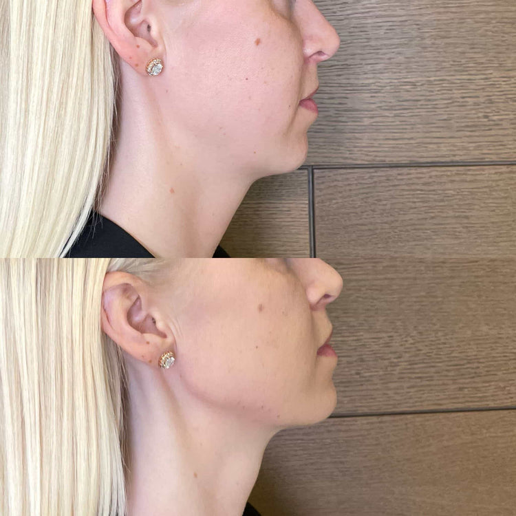 How to Minimize Pain During a Jaw Filler Procedure
